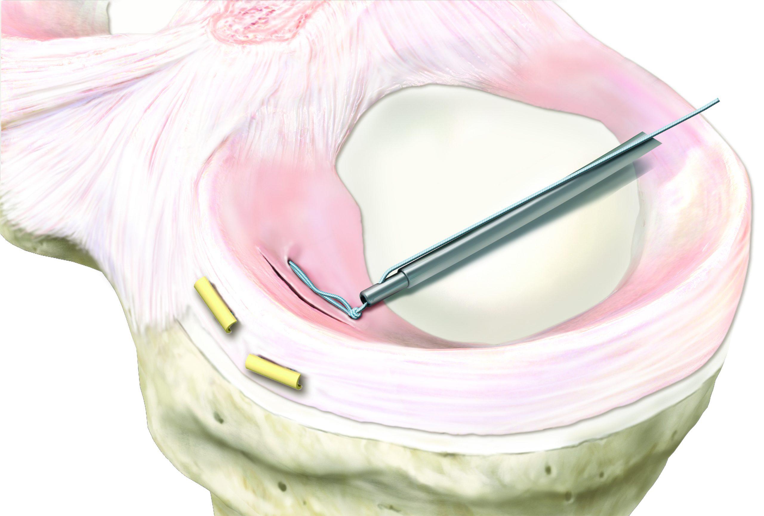 Meniscal Cinch™ - Image 3