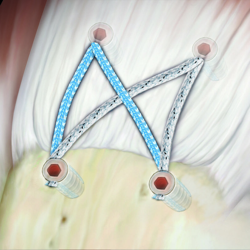 SpeedBridge™ Repair