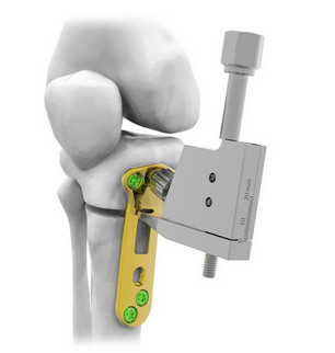 High Tibial Osteotomy